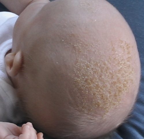 Side of a baby's head with a patch of yellowish, greasy-looking flakes on the scalp