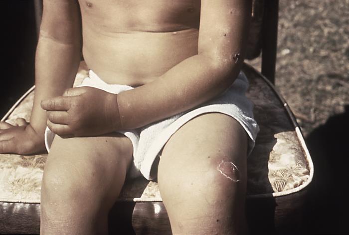 Beispiel von Impetigo-Hautstellen. Andere Erkrankungen können ähnlich aussehen; das Bild variiert nach Hautton. Ein Foto stellt keine Diagnose.