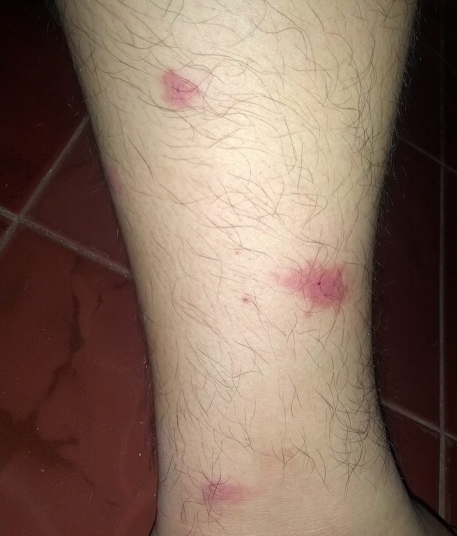 Una pierna con algunas picaduras dispersas, rojas, elevadas y un poco hinchadas