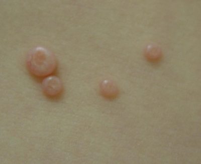 Close-up of five small, shiny, flesh-coloured bumps, some with a tiny dent in the centre