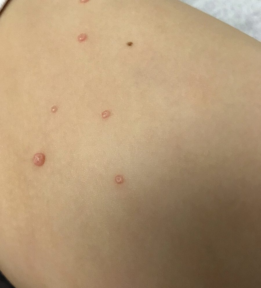 A young girl's thigh with scattered small, smooth, pink, dome-shaped bumps