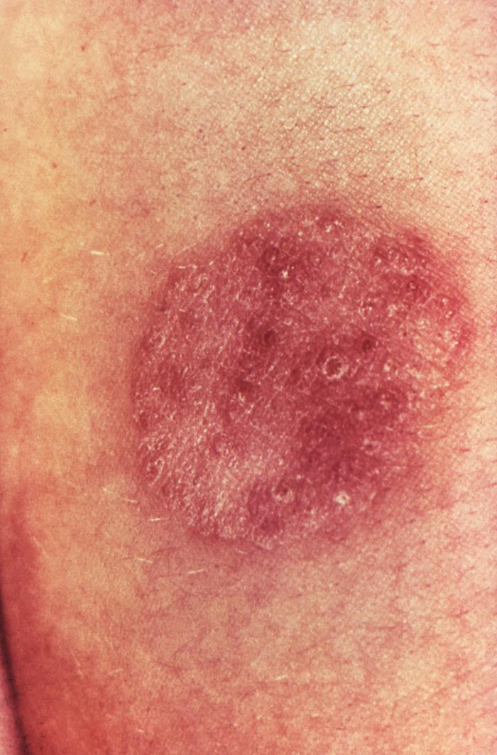 An example of ringworm on an arm. Appearance varies with skin tone and body site; a photograph cannot confirm the diagnosis.
