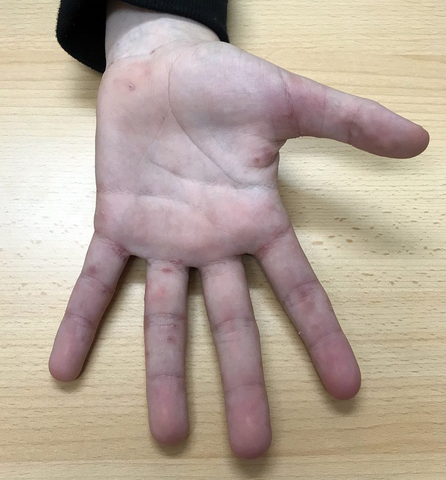 Handfläche und Finger eines Jugendlichen mit kleinen roten Knötchen und Kratzspuren, vor allem in den Fingerzwischenräumen und an den Fingerseiten