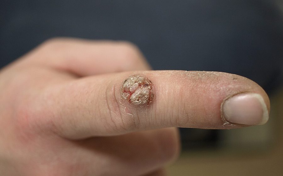 Ein Finger mit einer einzelnen erhabenen, rauen, blumenkohlartigen Warze an der Seite